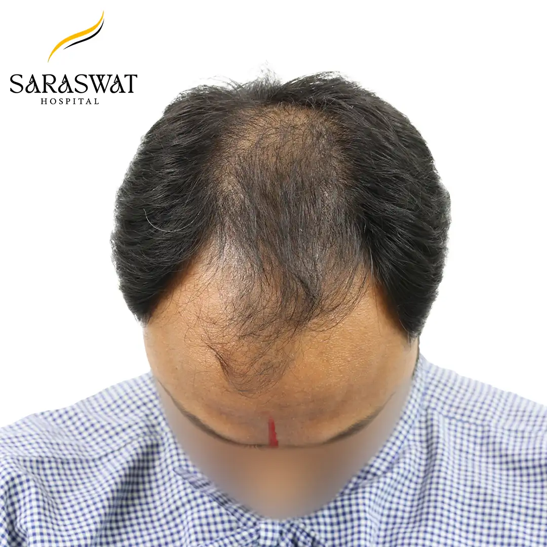 Top FUE Hair Transplant Result Before Procedure