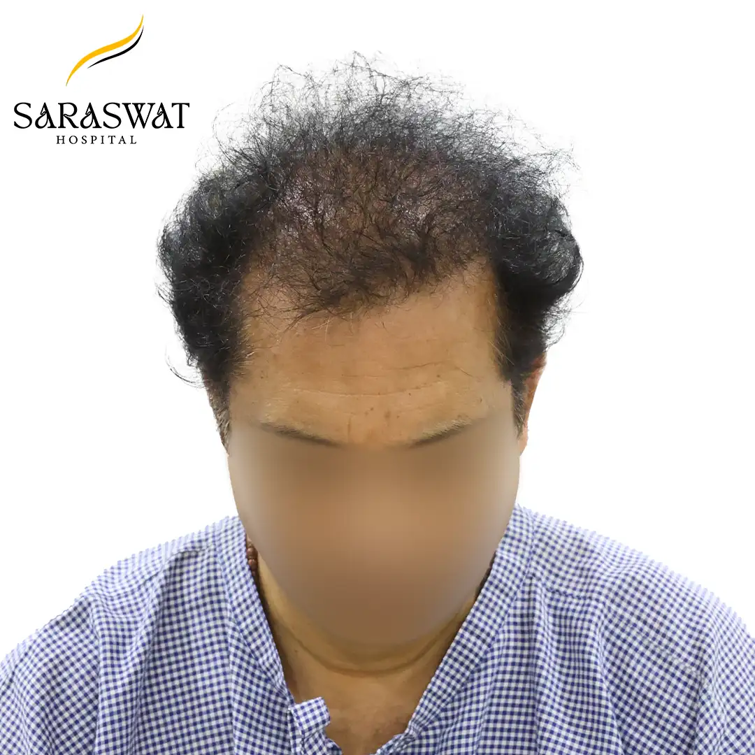 Hair Transplant Before Result