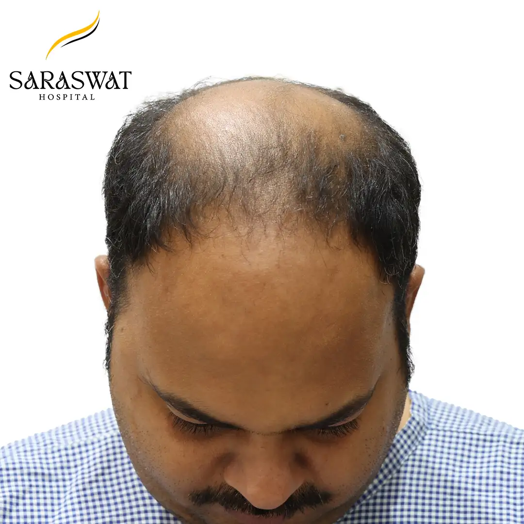 Top FUE Hair Transplant Result Before Procedure