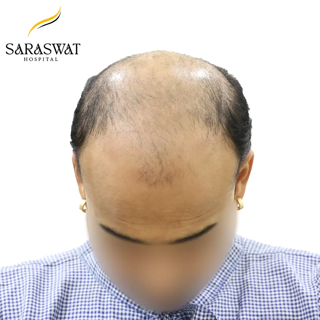Top FUE Hair Transplant Result Before Procedure