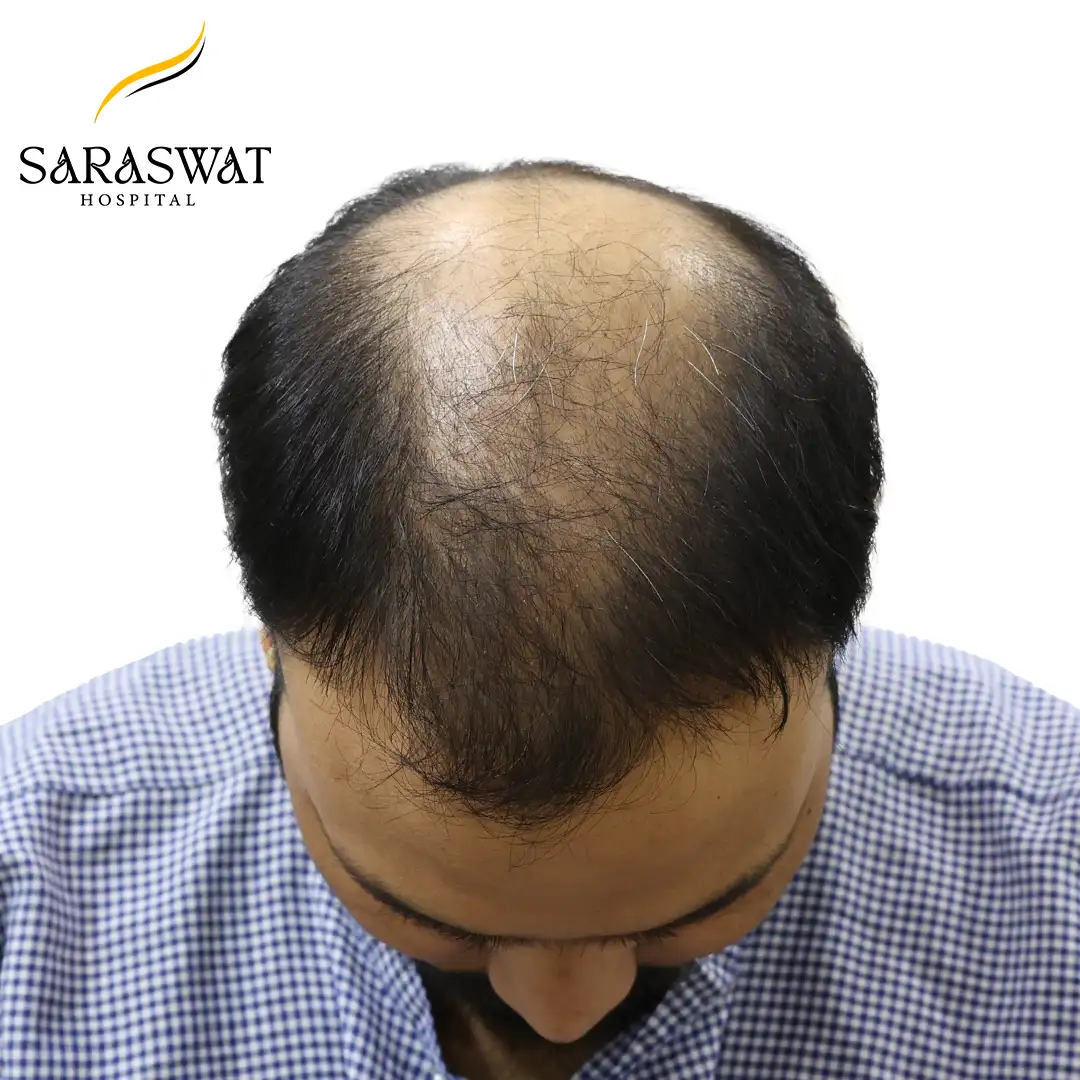 Top FUE Hair Transplant Result Before Procedure