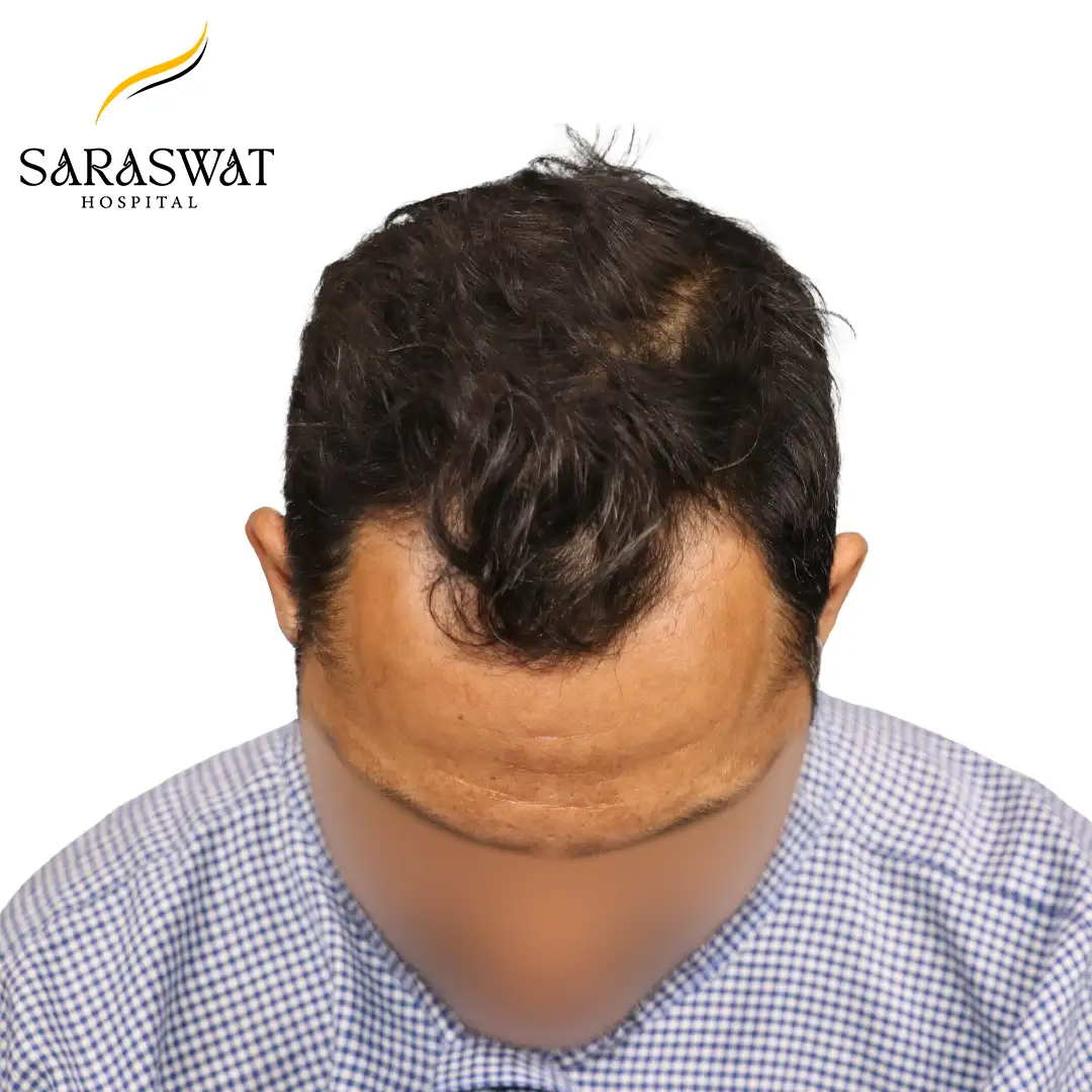 Top FUE Hair Transplant Result Before Procedure