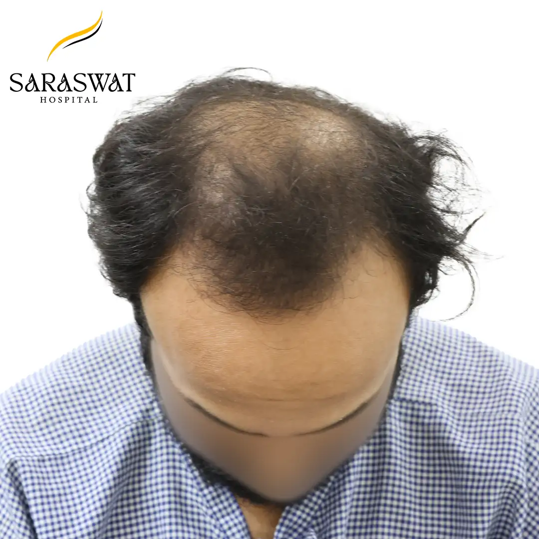 Top FUE Hair Transplant Result Before Procedure