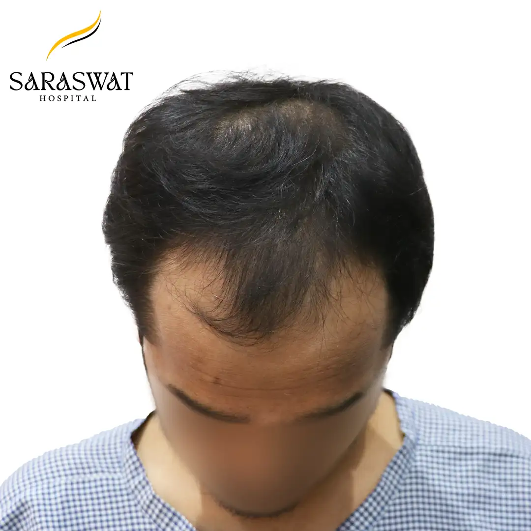 Top FUE Hair Transplant Result Before Procedure