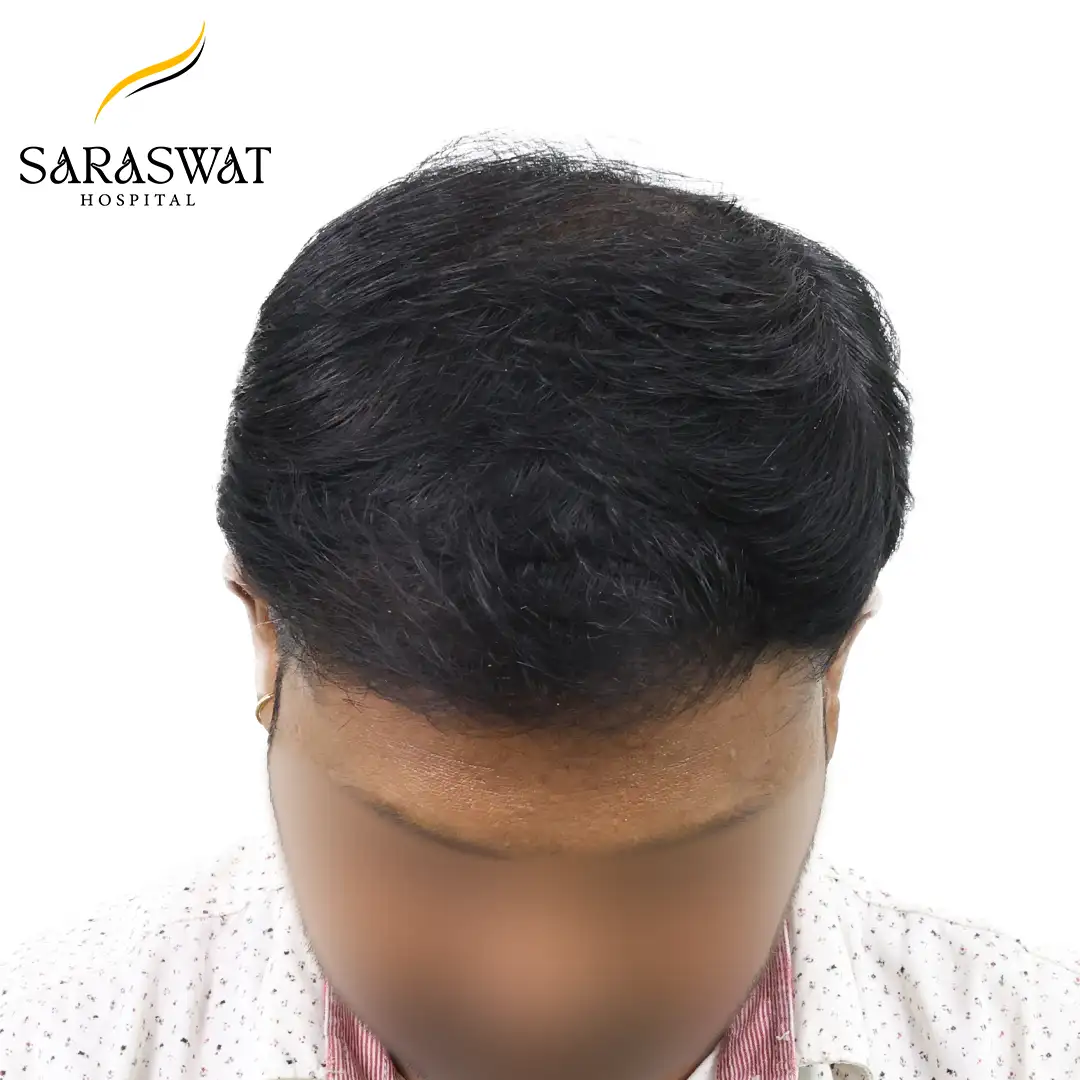 Hair Transplant Before and After