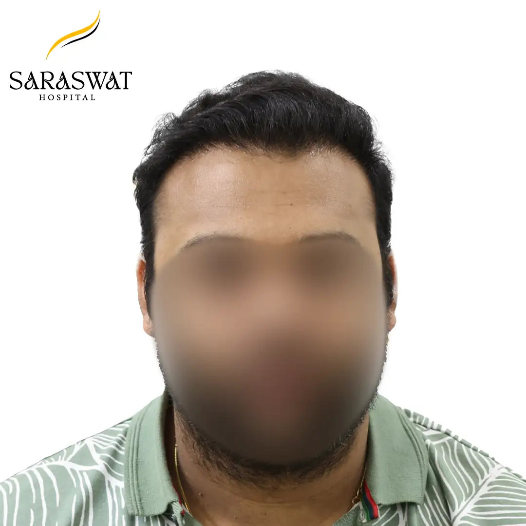 FUE Hair Transplant