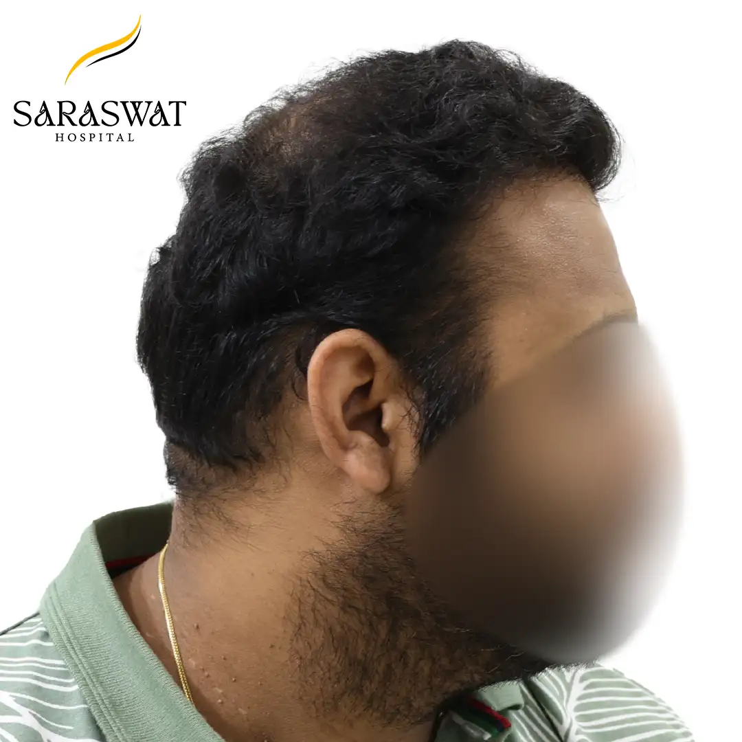 FUE Hair Transplant