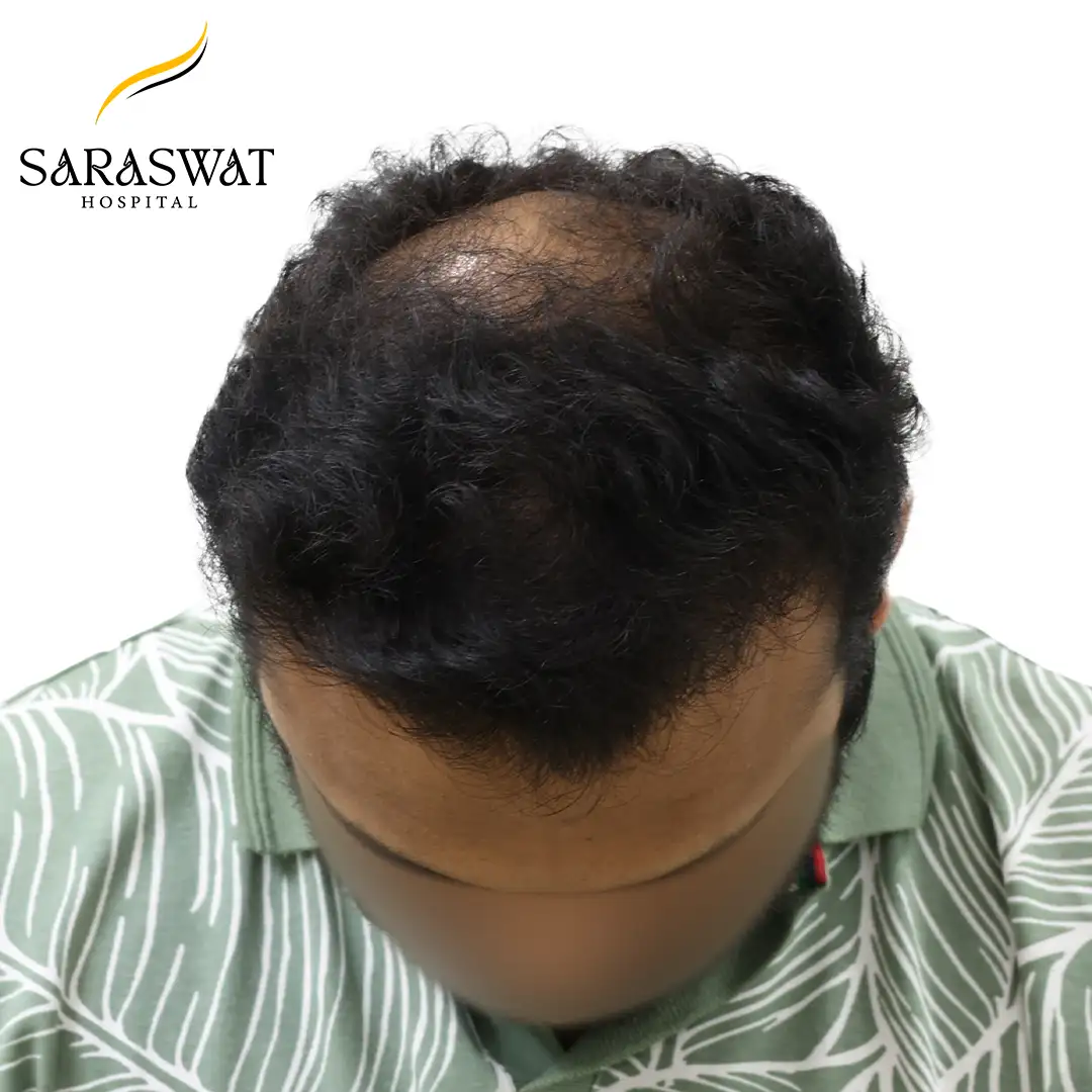 FUE Hair Transplant