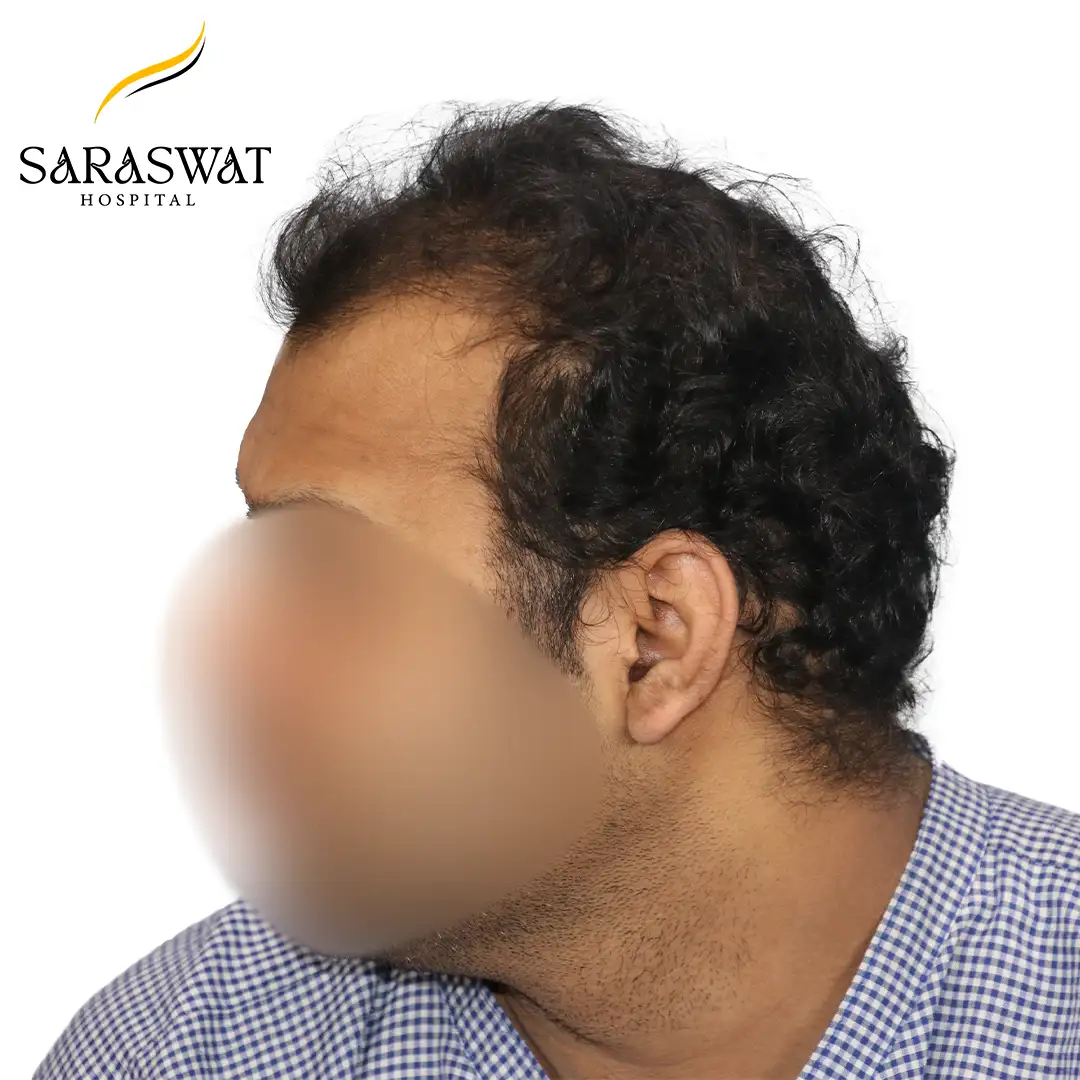 FUE Hair Transplant