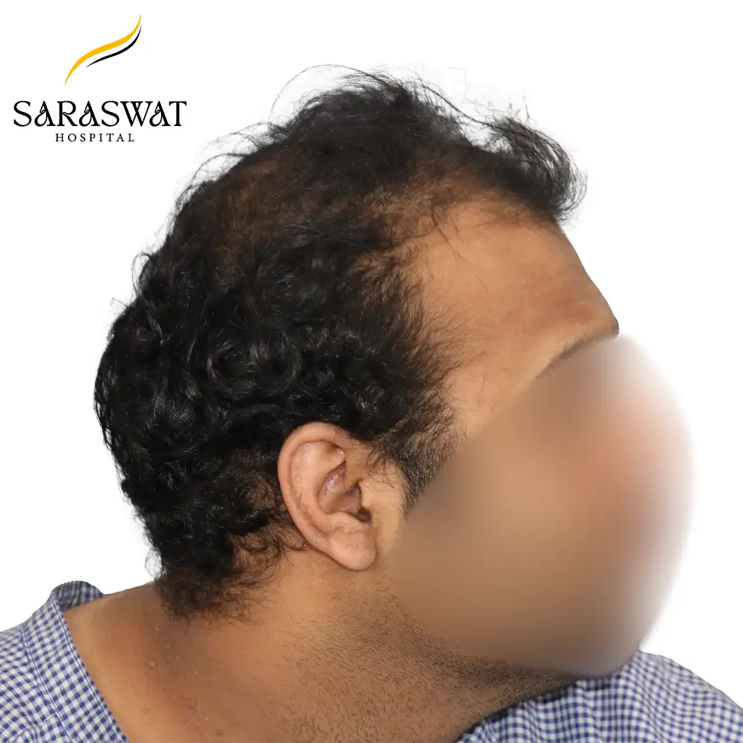 FUE Hair Transplant