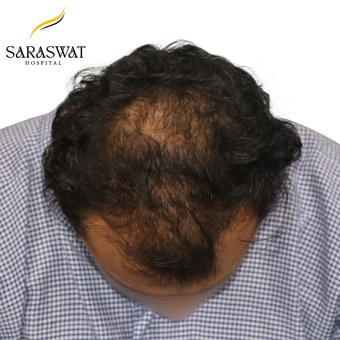 Causes of Male Pattern Baldness?