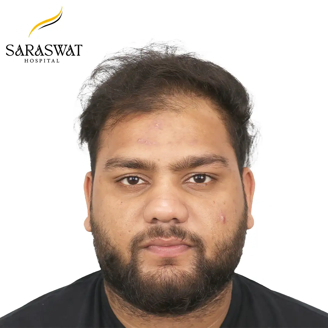 Front FUE Hair Transplant Result After Procedure