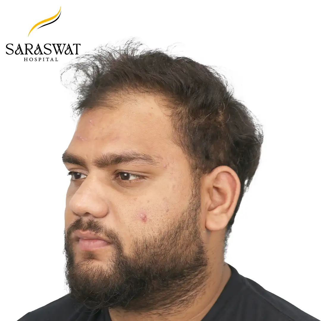 Hair Transplant Before After