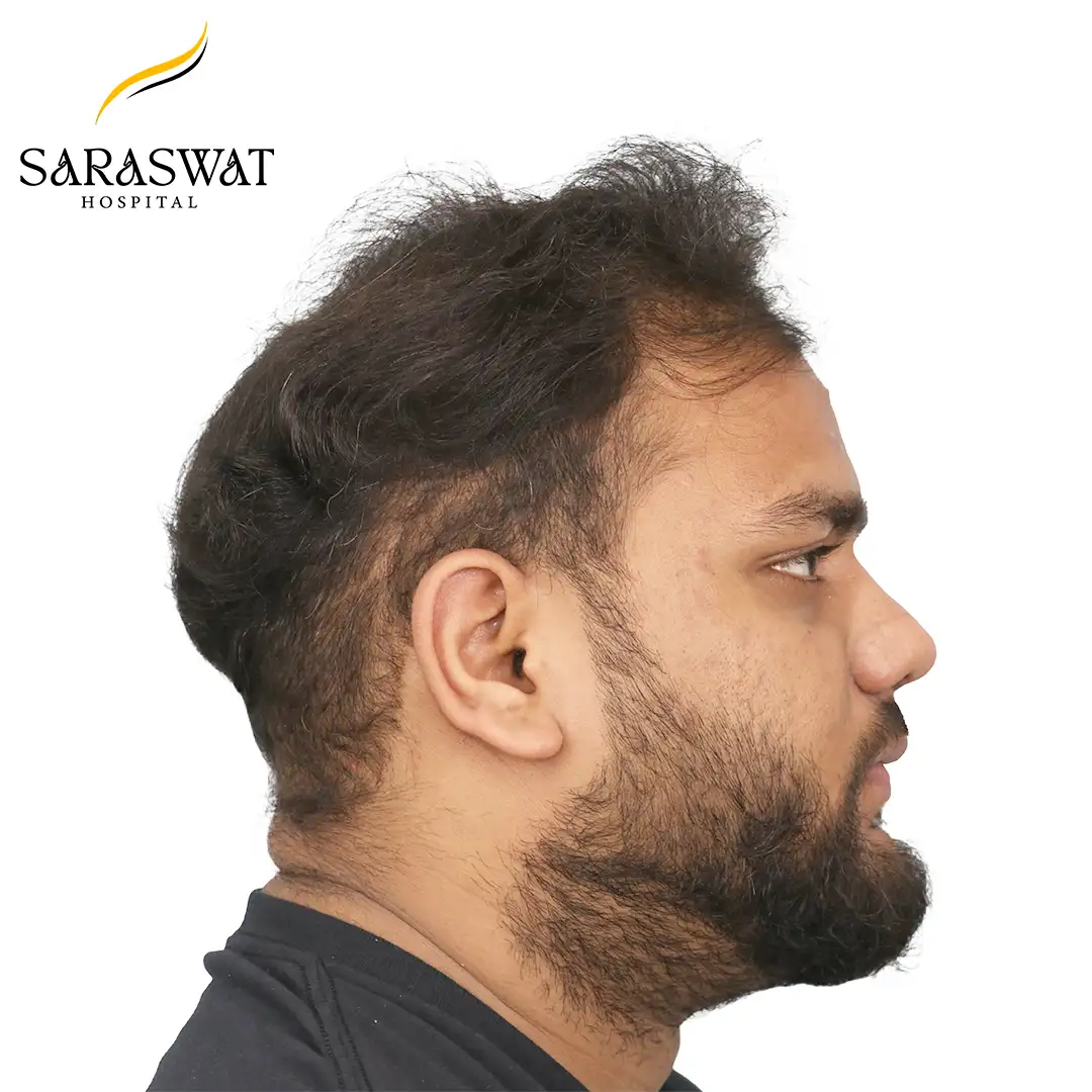 90 Degree Right FUE Hair Transplant Result After Procedure