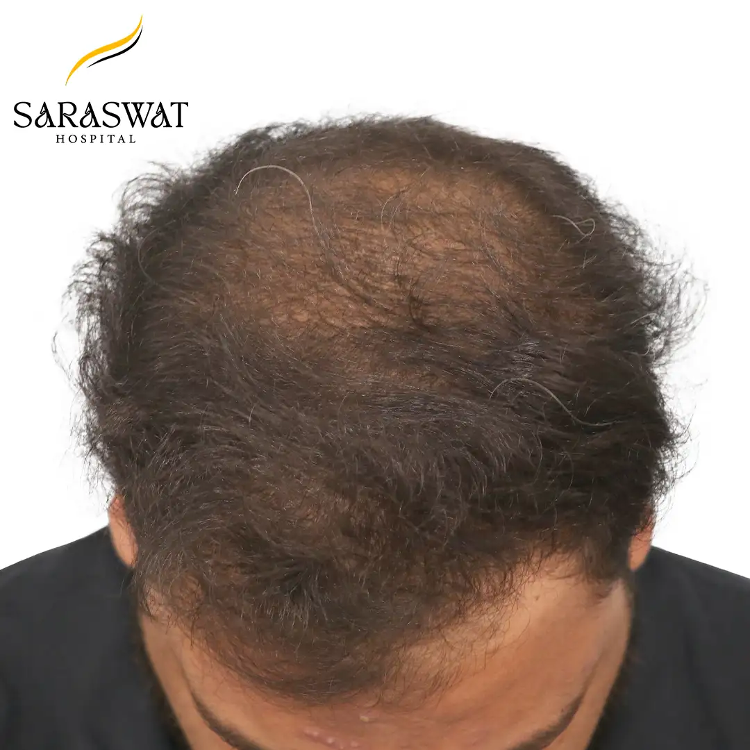 Top FUE Hair Transplant Result After Procedure
