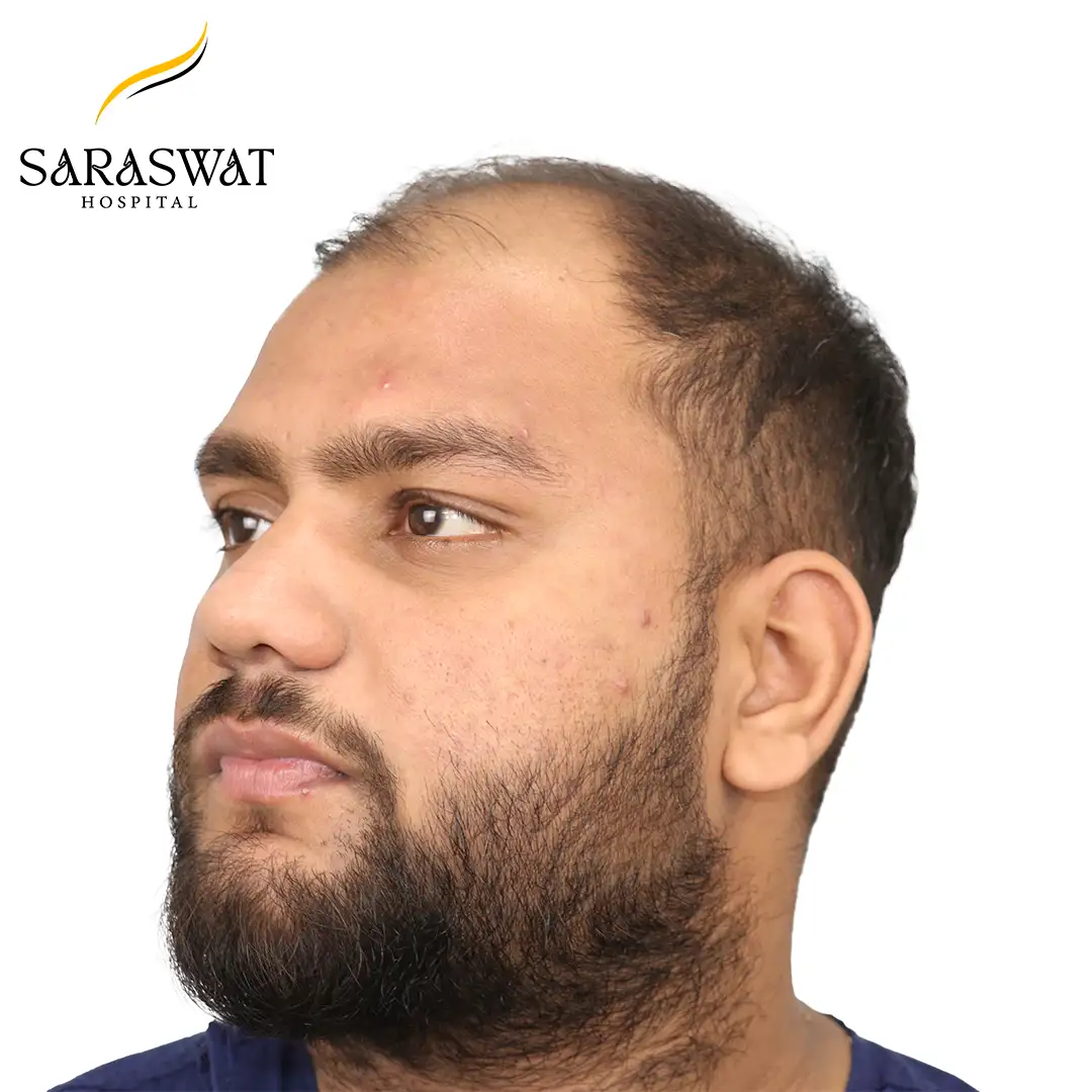 Hair Transplant Before After