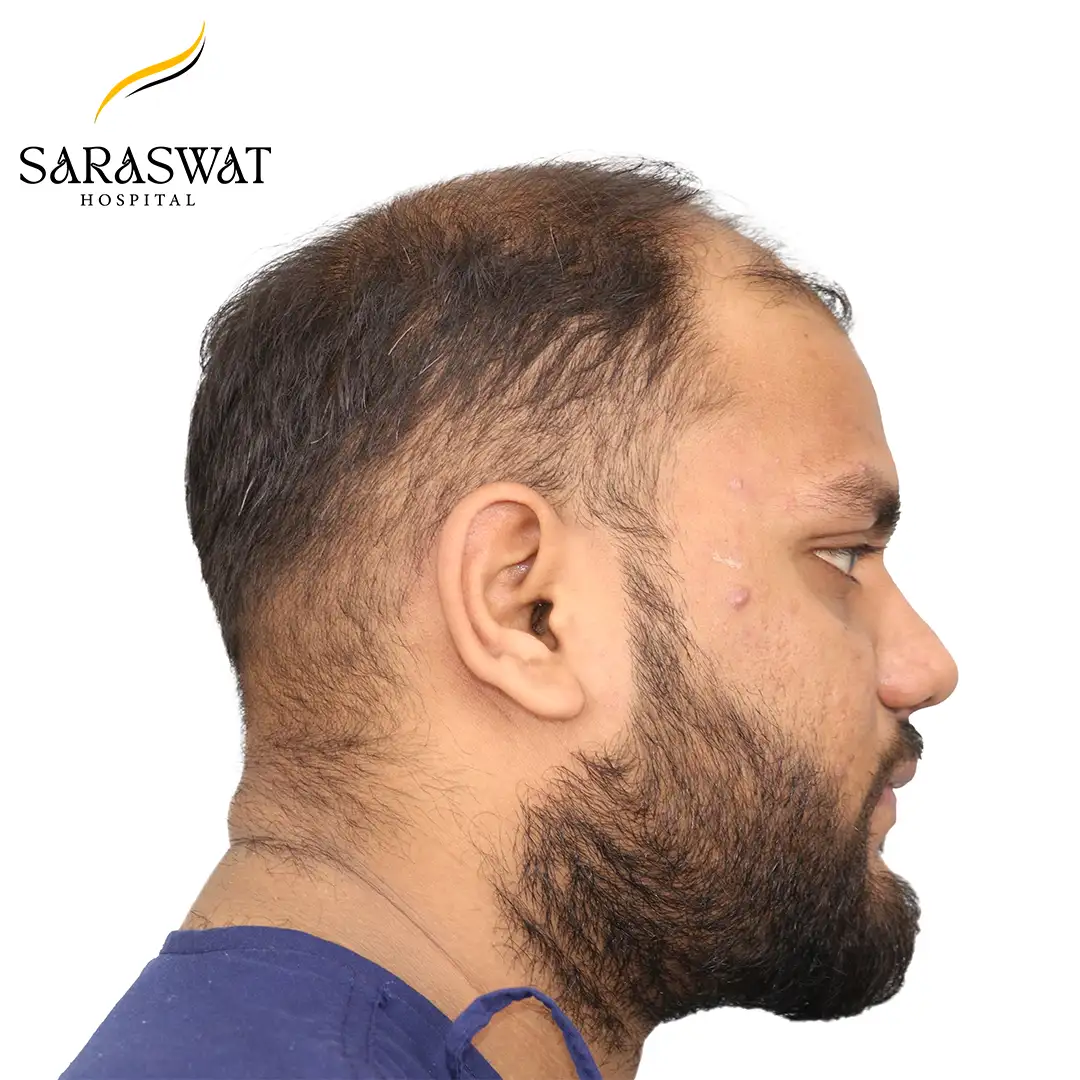 90 Degree Right FUE Hair Transplant Result Before Procedure