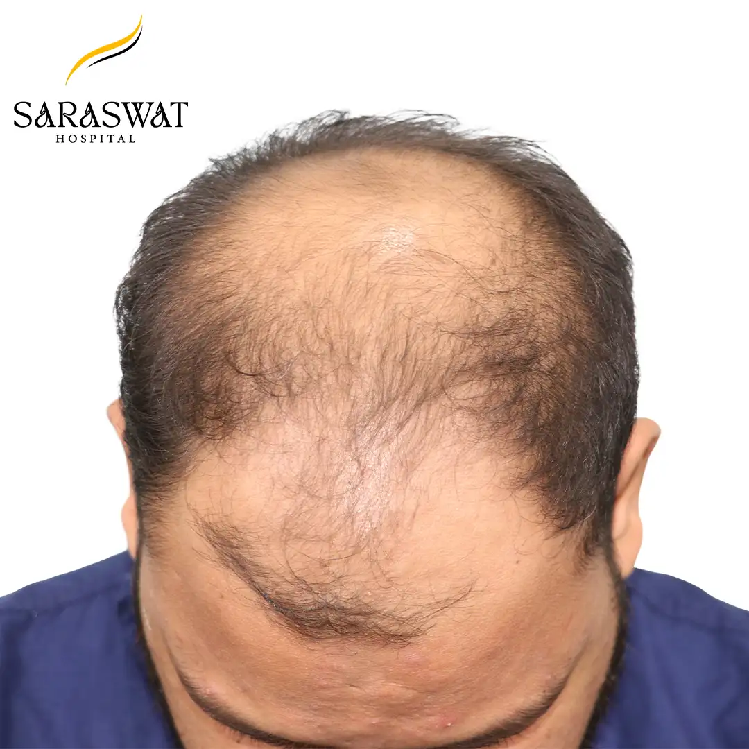Top FUE Hair Transplant Result Before Procedure