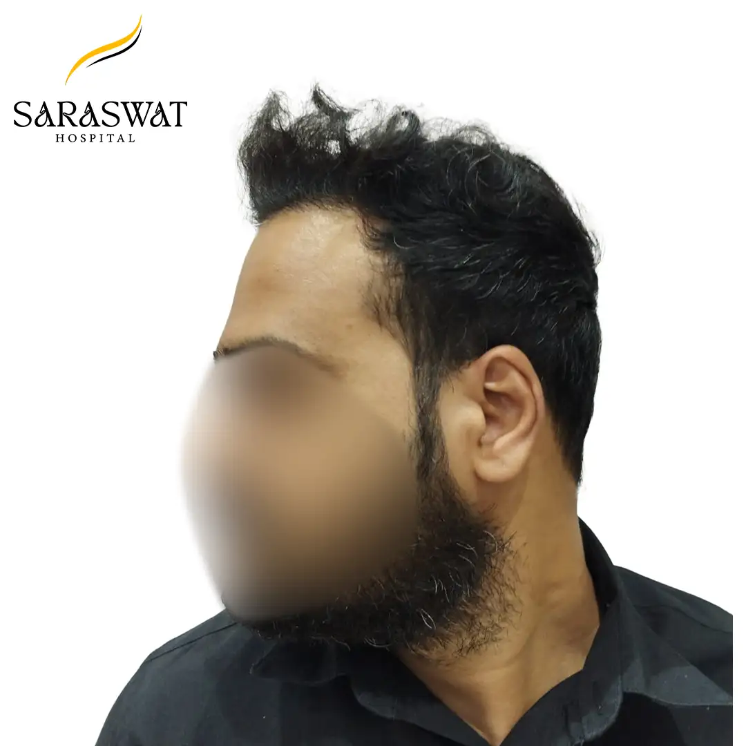 Hair Transplant Before and After Results