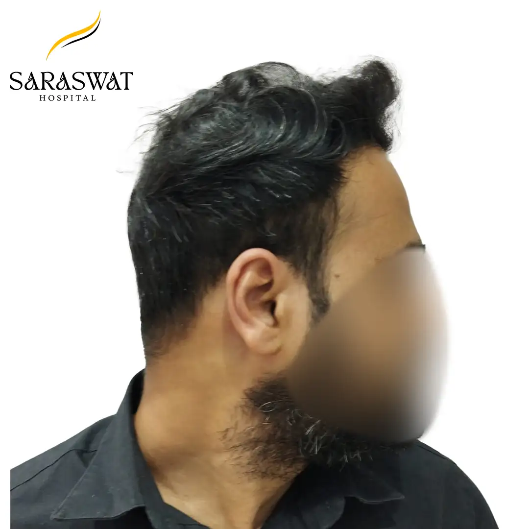 Hair Transplant Before After
