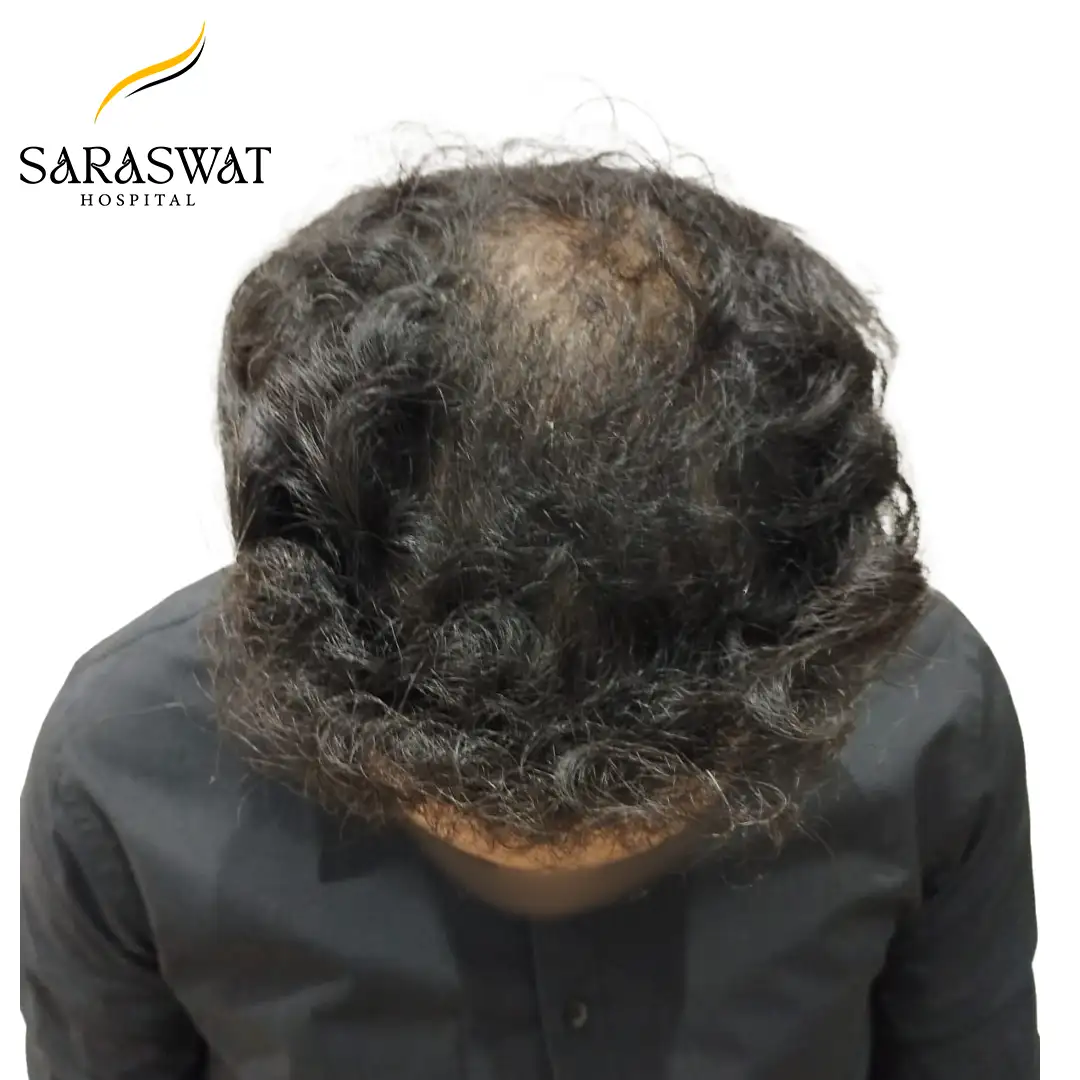 Top FUE Hair Transplant Result After Procedure