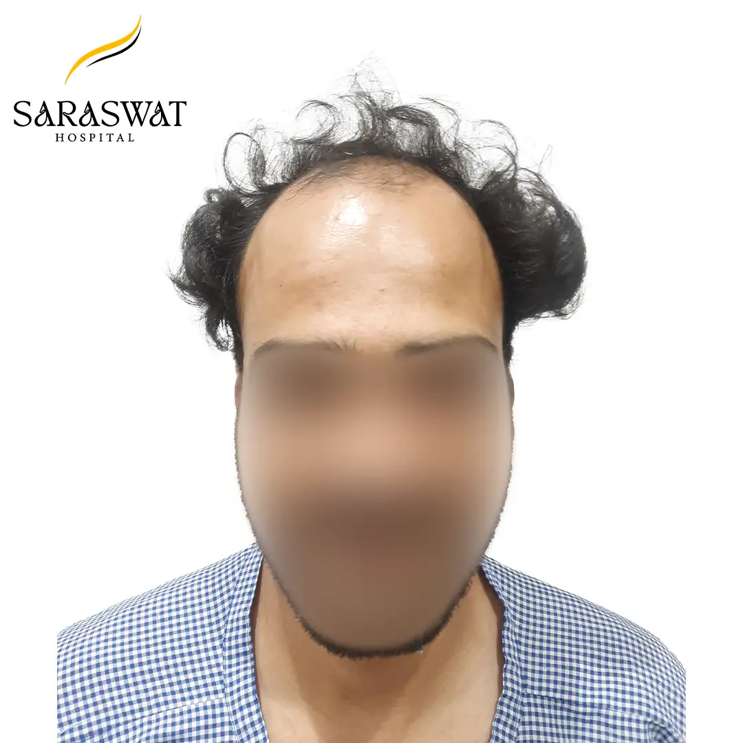 Front FUE Hair Transplant Result Before Procedure