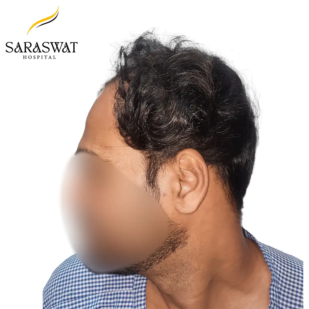 90 Degree Left FUE Hair Transplant Result Before Procedure