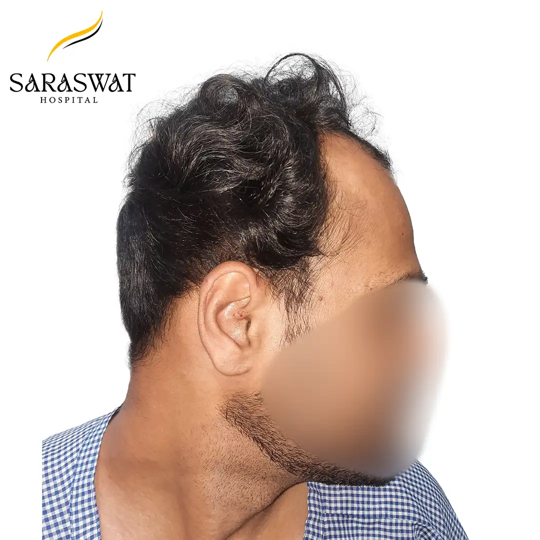 90 Degree Right FUE Hair Transplant Result Before Procedure