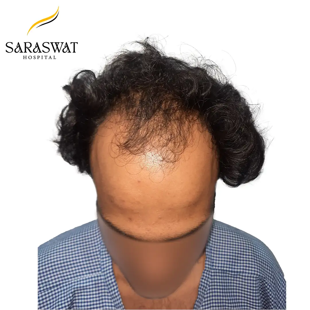 Top FUE Hair Transplant Result Before Procedure