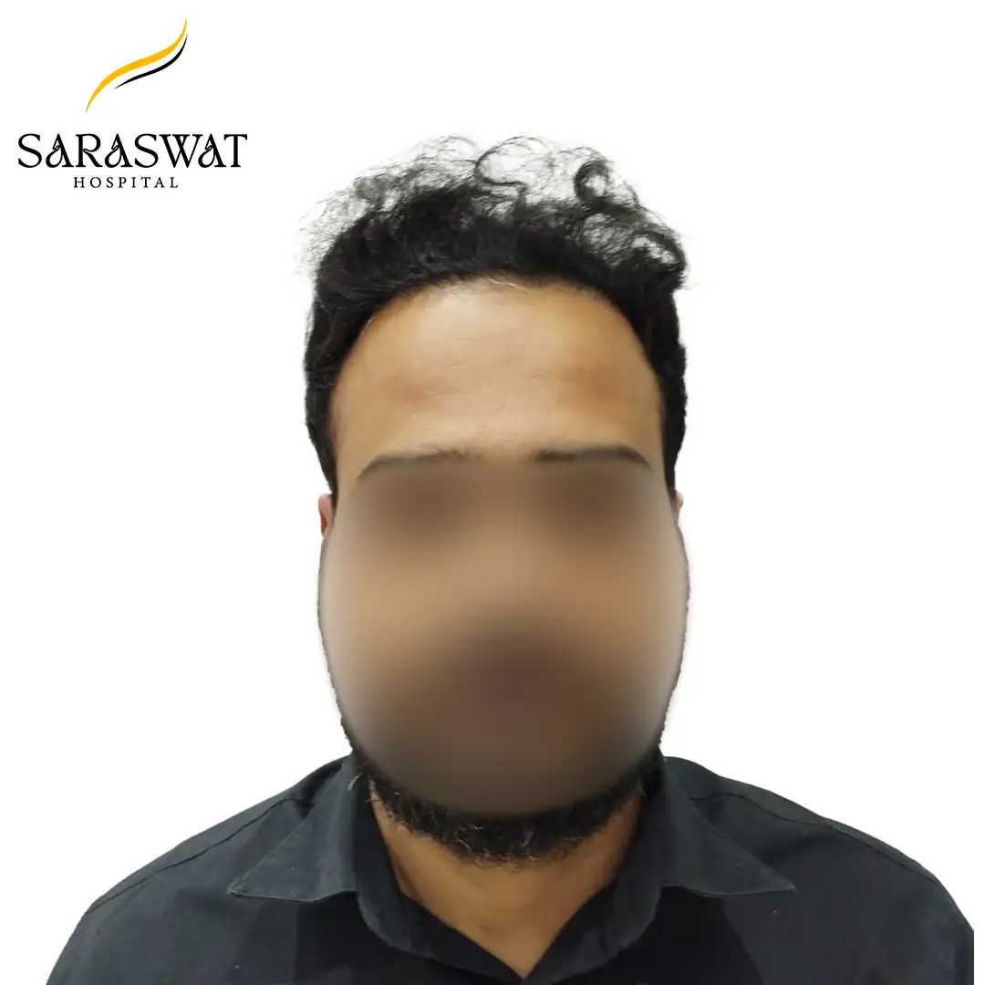 Front FUE Hair Transplant Result After Procedure