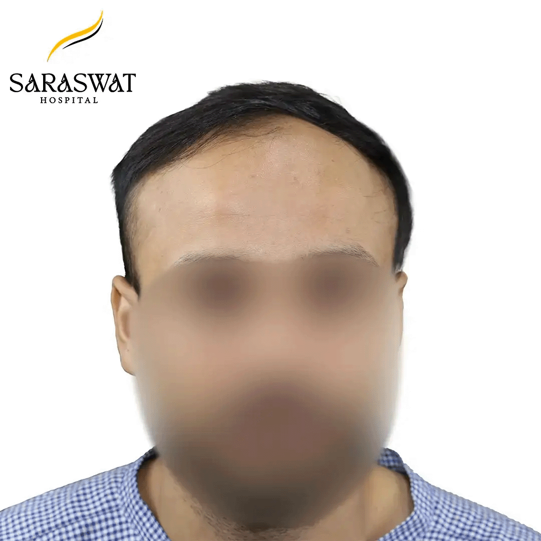 Hair Transplant Before and After Results