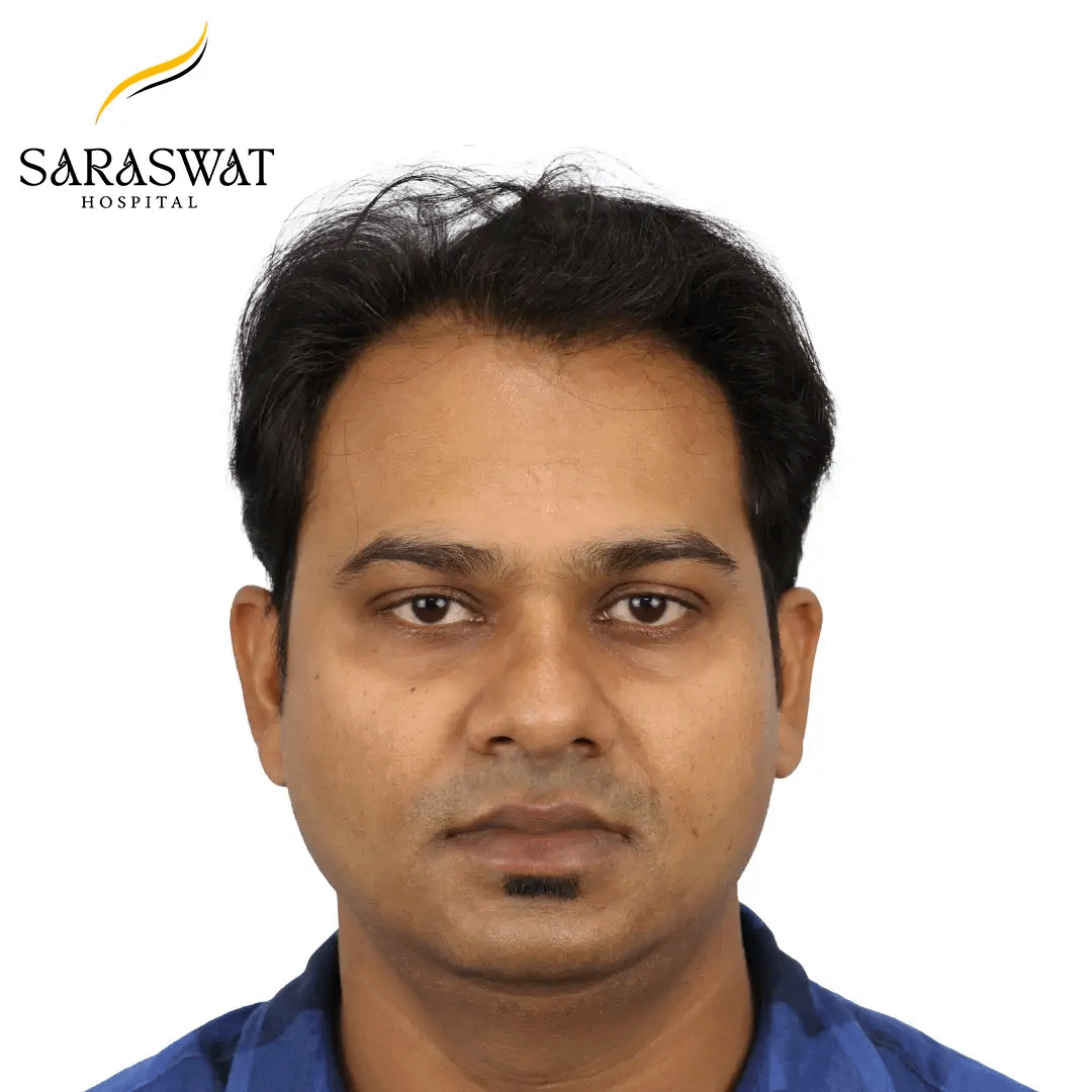 Hair Transplant Before and After Results