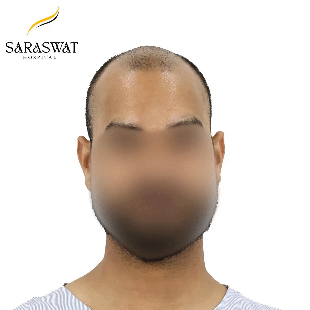 Hair Transplant Before and After Result