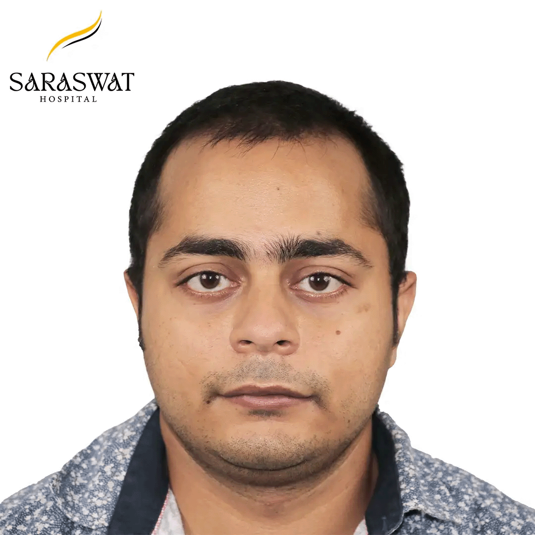 Hair Transplant Before and After Results