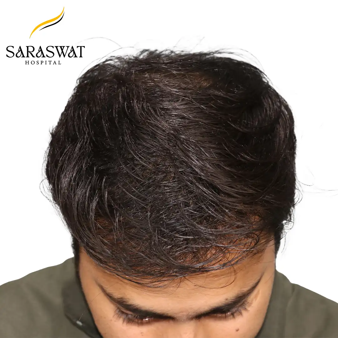 Hair Transplant Before After