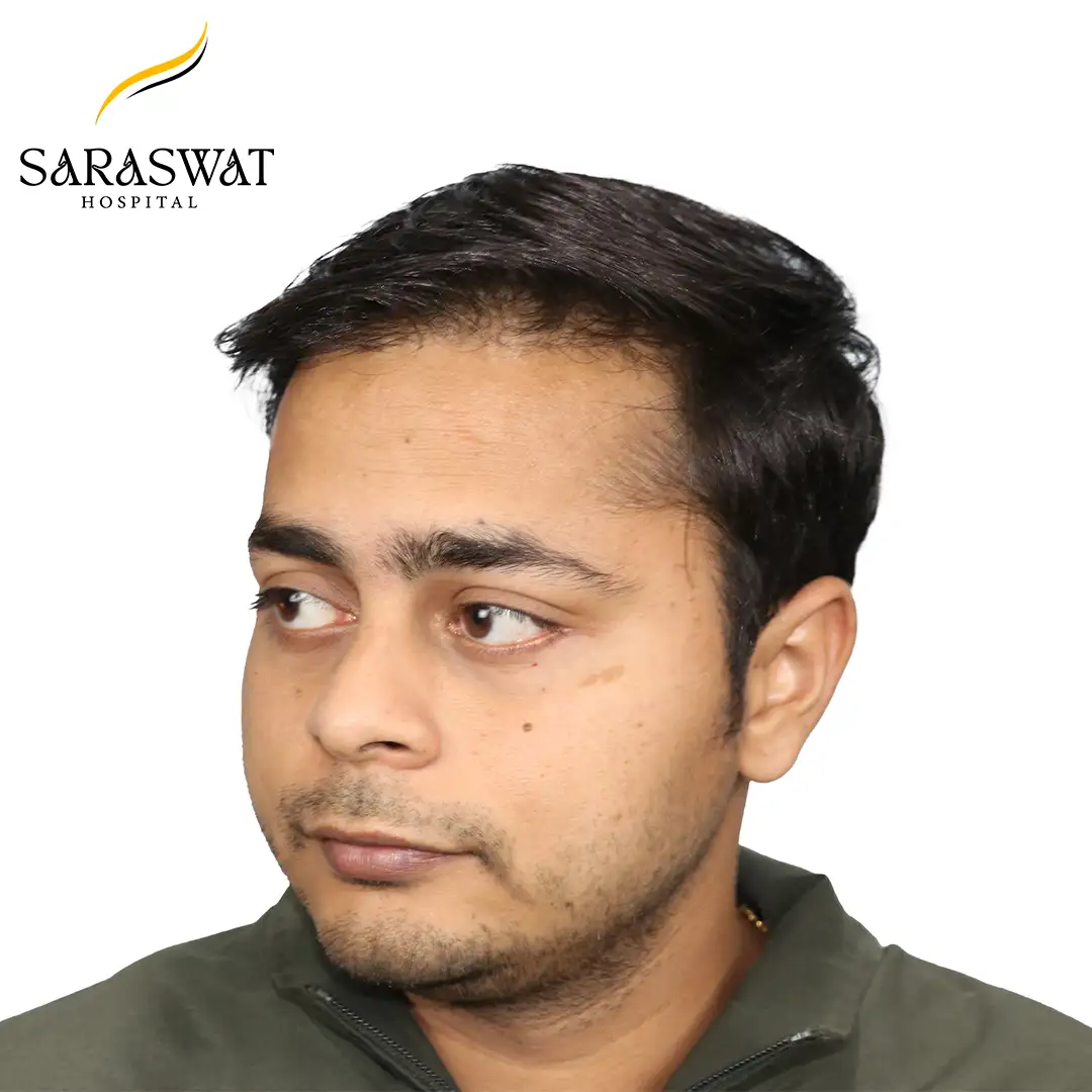 Hair Transplant Before After