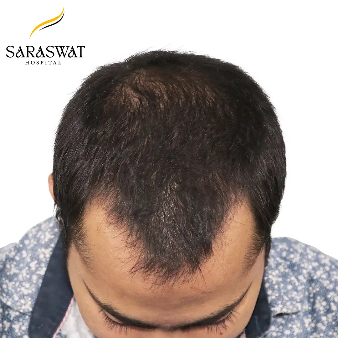 Hair Transplant Before After