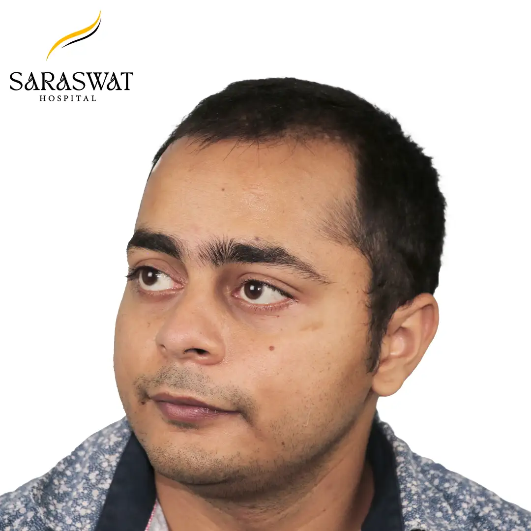 Hair Transplant Before After