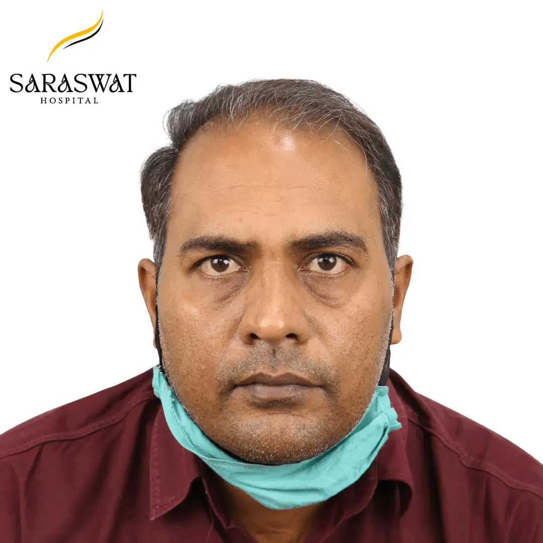 Hair Transplant Before and After