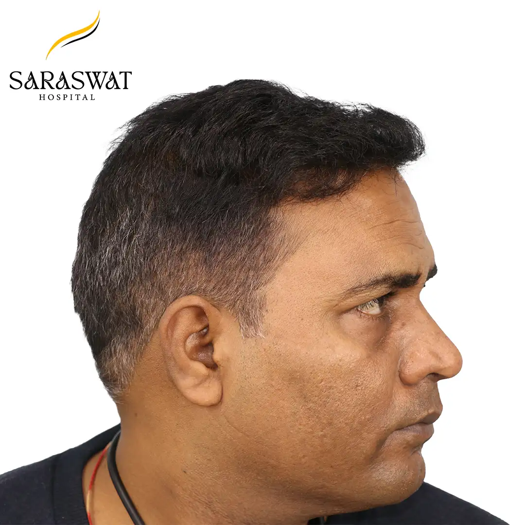 Hair Transplant Results
