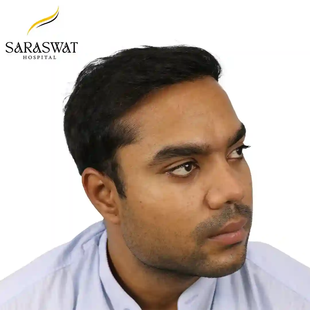 Hair Transplant Before and After