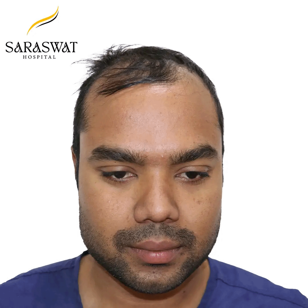 Hair Transplant Before and After
