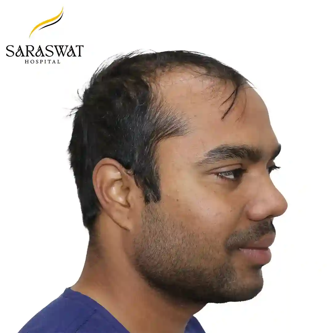 Hair Transplant Before Result