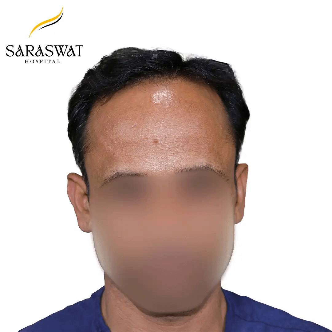 Hair Transplant Before and After Results