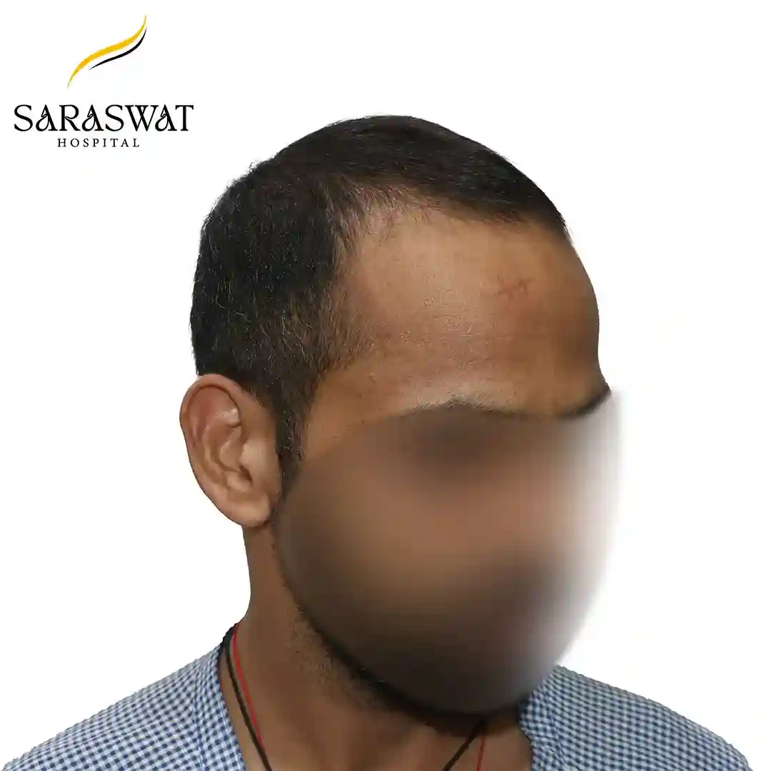 45 Degree Right FUE Hair Transplant Result Before Procedure