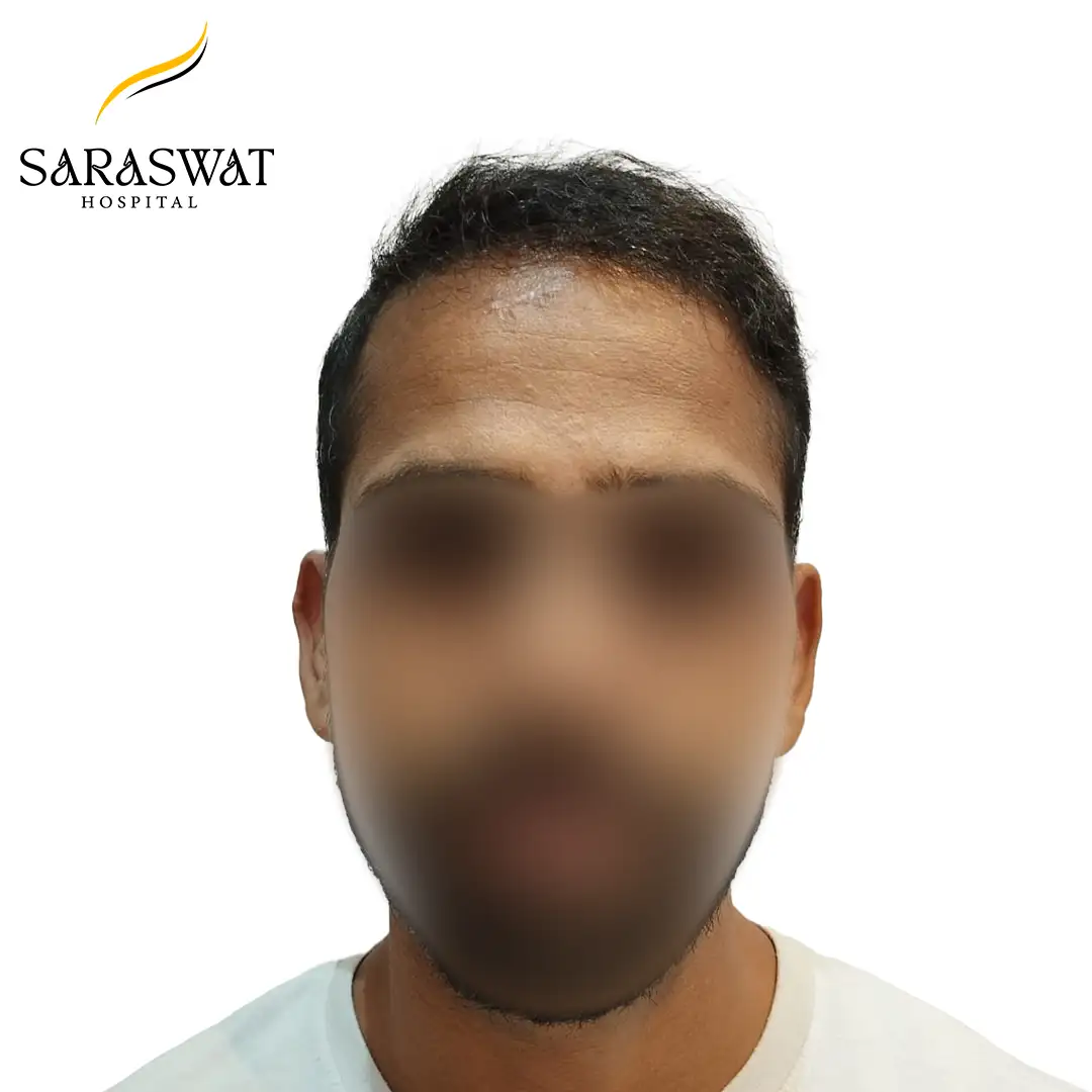 Front FUE Hair Transplant Result After Procedure