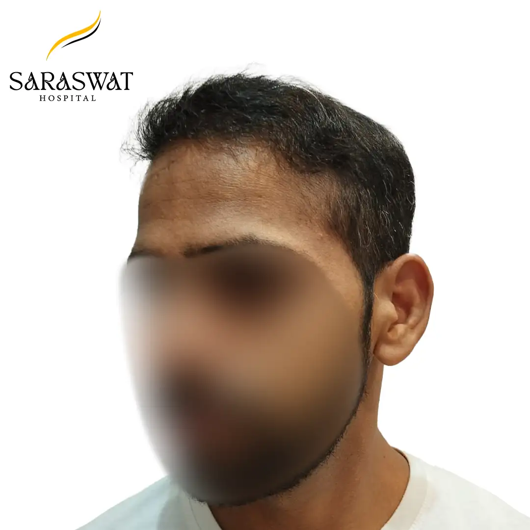 45 Degree Left FUE Hair Transplant Result After Procedure