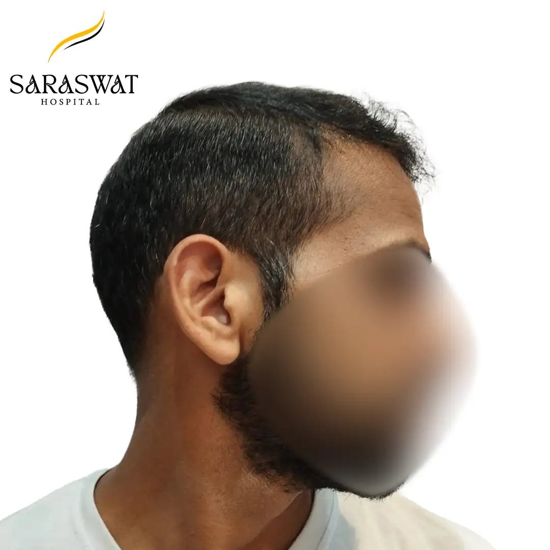 90 Degree Right FUE Hair Transplant Result After Procedure