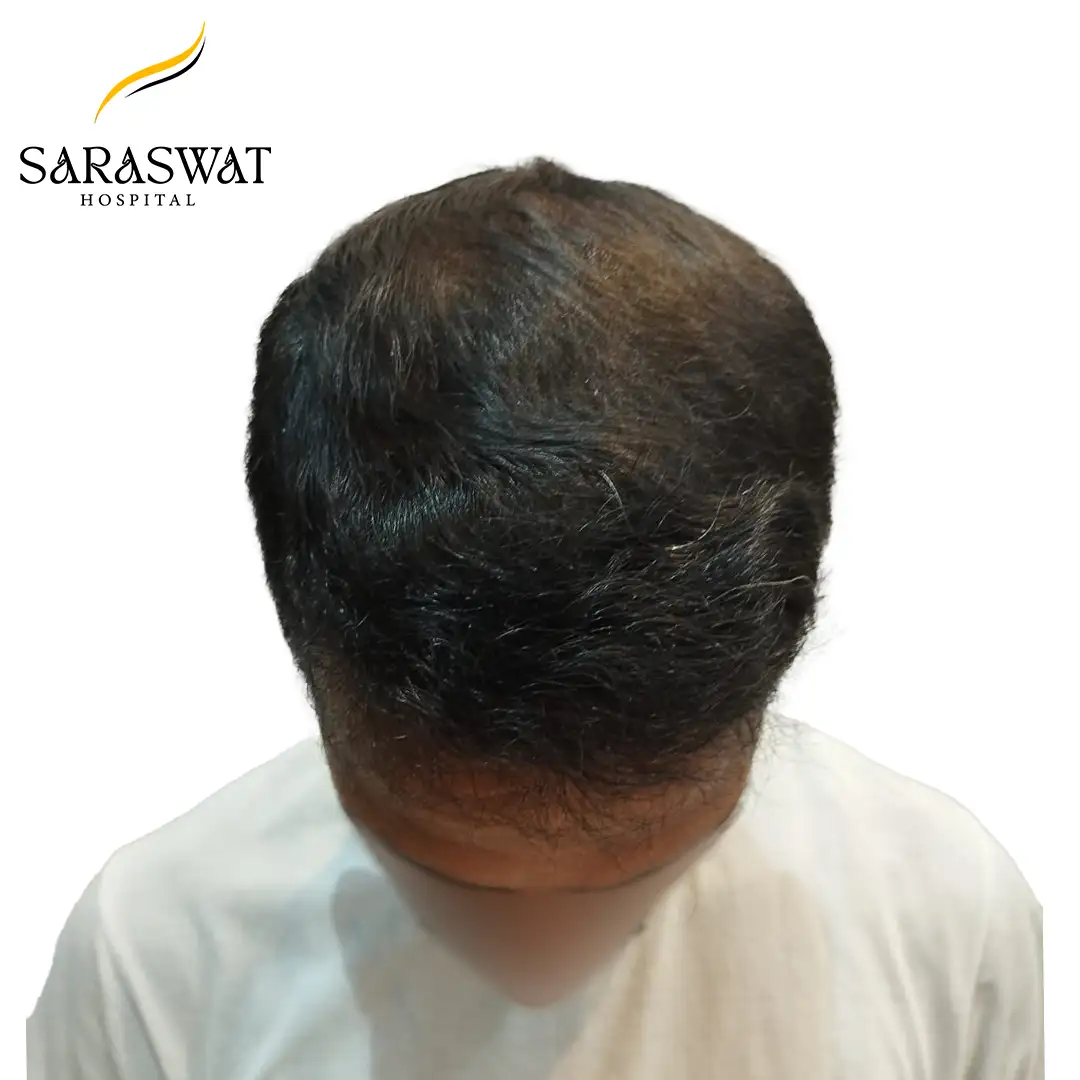 Top FUE Hair Transplant Result After Procedure