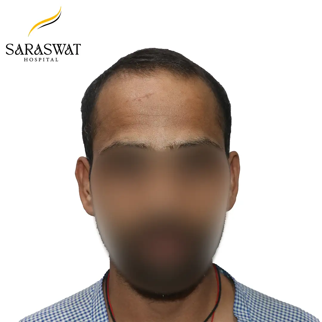 Front FUE Hair Transplant Result Before Procedure